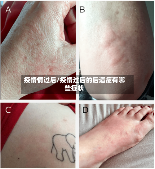 疫情情过后/疫情过后的后遗症有哪些症状-第2张图片