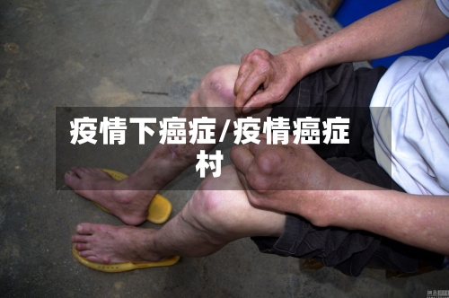 疫情下癌症/疫情癌症村-第2张图片